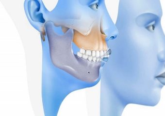 مراقبت های پس از جراحی فک | بهترین دندانپزشک اصفهان - بهترین ایمپلنت اصفهان - بهترین دندانپزشک زیبایی اصفهان - بهترین دندانپزشک کودکان اصفهان