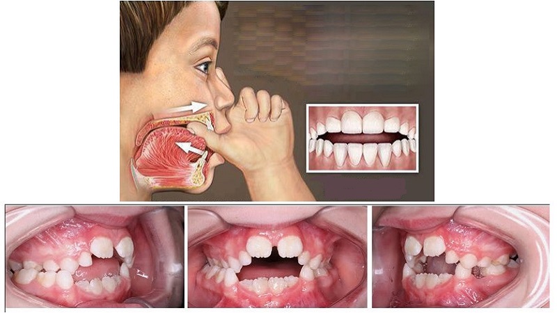 رابطه مکیدن انگشت و رویش دندان در کودکان | بهترین دندانپزشک اصفهان - بهترین ایمپلنت اصفهان - بهترین دندانپزشک زیبایی اصفهان - بهترین دندانپزشک کودکان اصفهان