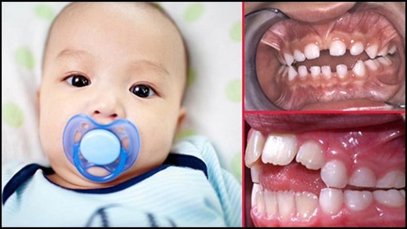 علت انگشت خوردن کودکان | بهترین دندانپزشک اصفهان - بهترین ایمپلنت اصفهان - بهترین دندانپزشک زیبایی اصفهان - بهترین دندانپزشک کودکان اصفهان