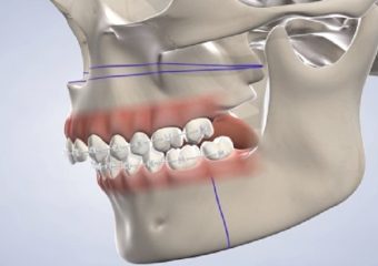 اقدامات قبل از جراحی فک | بهترین دندانپزشک اصفهان - بهترین ایمپلنت اصفهان - بهترین دندانپزشک زیبایی اصفهان - بهترین دندانپزشک کودکان اصفهان