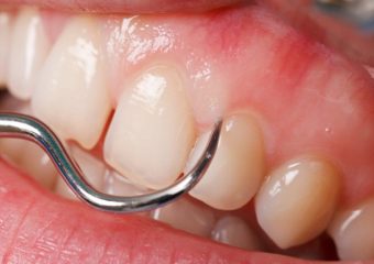 سفیدشدن لثه در خانه | بهترین دندانپزشک اصفهان - بهترین ایمپلنت اصفهان - بهترین دندانپزشک زیبایی اصفهان - بهترین دندانپزشک کودکان اصفهان