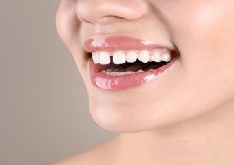 فاصله بین دندان ها چه مشکلاتی به وجود می آورد؟ | بهترین دندانپزشک اصفهان - بهترین ایمپلنت اصفهان - بهترین دندانپزشک زیبایی اصفهان - بهترین دندانپزشک کودکان اصفهان