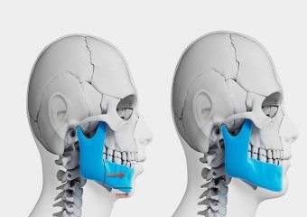 انواع جراحی فک یا ارتوسرجری | بهترین دندانپزشک اصفهان - بهترین ایمپلنت اصفهان - بهترین دندانپزشک زیبایی اصفهان - بهترین دندانپزشک کودکان اصفهان