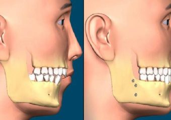 علائم و تشخیص چانه عقب رفته | بهترین دندانپزشک اصفهان - بهترین ایمپلنت اصفهان - بهترین دندانپزشک زیبایی اصفهان - بهترین دندانپزشک کودکان اصفهان