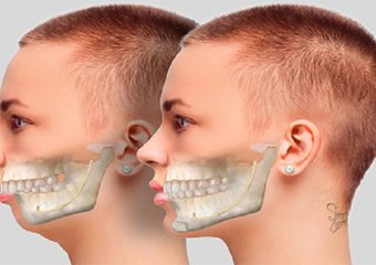 علائم و تشخیص چانه عقب رفته | بهترین دندانپزشک اصفهان - بهترین ایمپلنت اصفهان - بهترین دندانپزشک زیبایی اصفهان - بهترین دندانپزشک کودکان اصفهان