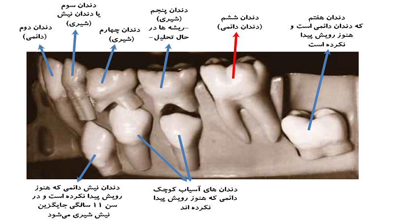 پیشگیری از پوسیدگی دندان های شش | بهترین دندانپزشک اصفهان - بهترین ایمپلنت اصفهان - بهترین دندانپزشک زیبایی اصفهان - بهترین دندانپزشک کودکان اصفهان
