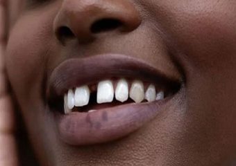 روش های بستن فاصله بین دندانها (قسمت پنجم) | بهترین دندانپزشک اصفهان - بهترین ایمپلنت اصفهان - بهترین دندانپزشک زیبایی اصفهان - بهترین دندانپزشک کودکان اصفهان