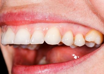 علل و علائم سفید شدن لثه | بهترین دندانپزشک اصفهان - بهترین ایمپلنت اصفهان - بهترین دندانپزشک زیبایی اصفهان - بهترین دندانپزشک کودکان اصفهان