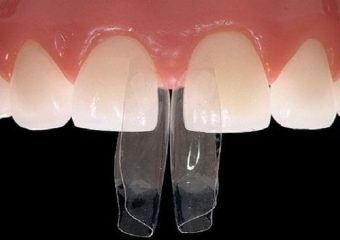 نکاتی در مورد فاصله بین دندان ها | بهترین دندانپزشک اصفهان - بهترین ایمپلنت اصفهان - بهترین دندانپزشک زیبایی اصفهان - بهترین دندانپزشک کودکان اصفهان