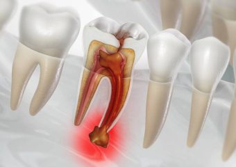 بهترین ایمپلنت اصفهان | بهترین دندانپزشک زیبایی اصفهان | دکتر مکانیک | بهترین دندانپزشک اصفهان | بهترین دندانپزشک کودکان اصفهان | پالپ دندان