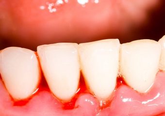 بهترین ایمپلنت اصفهان | بهترین دندانپزشک زیبایی اصفهان | دکتر مکانیک | بهترین دندانپزشک اصفهان | بهترین دندانپزشک کودکان اصفهان |علل خونریزی لثه در کودکان