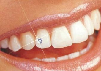 عوارض کاشت نگین روی دندان | بهترین ایمپلنت اصفهان | بهترین دندانپزشک زیبایی اصفهان | دکتر مکانیک | بهترین دندانپزشک اصفهان | بهترین دندانپزشک کودکان اصفهان |