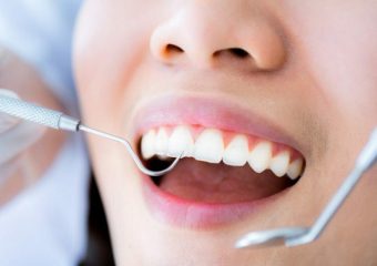 بهترین ایمپلنت اصفهان | بهترین دندانپزشک زیبایی اصفهان | دکتر مکانیک | بهترین دندانپزشک اصفهان | بهترین دندانپزشک کودکان اصفهان | ماملون دندان چیست؟