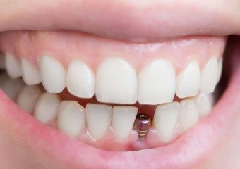 مراحل مشترک کاشت ایمپلنت دندان | بهترین ایمپلنت اصفهان | بهترین دندانپزشک زیبایی اصفهان | دکتر مکانیک | بهترین دندانپزشک اصفهان | بهترین دندانپزشک کودکان اصفهان |