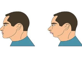 چانه عقب رفته چیست؟ | بهترین دندانپزشک اصفهان - بهترین ایمپلنت اصفهان - بهترین دندانپزشک زیبایی اصفهان - بهترین دندانپزشک کودکان اصفهان