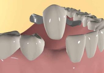 آشنایی با بریج دندان مریلند | بهترین ایمپلنت اصفهان | بهترین دندانپزشک زیبایی اصفهان | دکتر ندا مکانیک