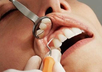 آشنایی با علل دندان صدفی | بهترین ایمپلنت اصفهان