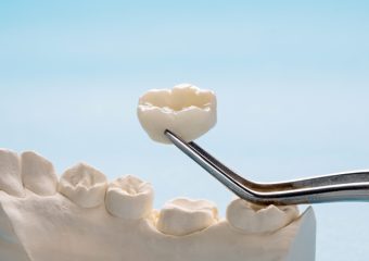 انواع تاج دندان یا کراون | بهترین ایمپلنت اصفهان | دکتر ندا مکانیک