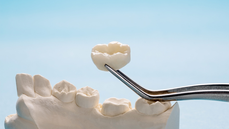 انواع تاج دندان یا کراون | بهترین ایمپلنت اصفهان | دکتر ندا مکانیک