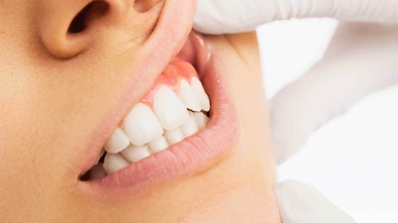 علل ورم لثه | بهترین دندانپزشک کودکان اصفهان