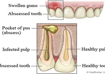 بهترین ایمپلنت اصفهان | بهترین دندانپزشک زیبایی اصفهان | عوارض درمان نکردن دندان به عصب رسیده | بهترین دندانپزشک زیبایی اصفهان | دکتر ندا مکانیک