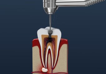 عوارض عصب کشی دندان | بهترین ایمپلنت اصفهان | بهترین دندانپزشک زیبایی اصفهان | دکتر مکانیک | بهترین دندانپزشک اصفهان | بهترین دندانپزشک کودکان اصفهان |