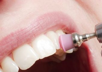 بهترین ایمپلنت اصفهان | بهترین دندانپزشک زیبایی اصفهان | مراقبت های لازم بعد از پالیش کامپوزیت دندان | بهترین دندانپزشک کودکان اصفهان | دکتر ندا مکانیک