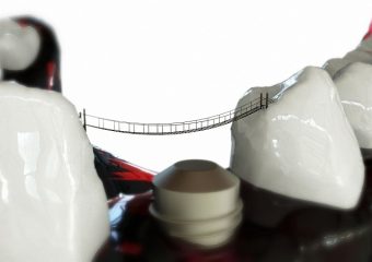 مزایا و معایب بریج دندان مریلند | بهترین دندانپزشک زیبایی اصفهان | دکتر ندا مکانیک