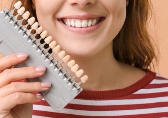 بهترین ایمپلنت اصفهان | بهترین دندانپزشک زیبایی اصفهان | مقایسه کامپوزیت و پرسلن دندان | بهترین ایمپلنت اصفهان | دکتر ندا مکانیک