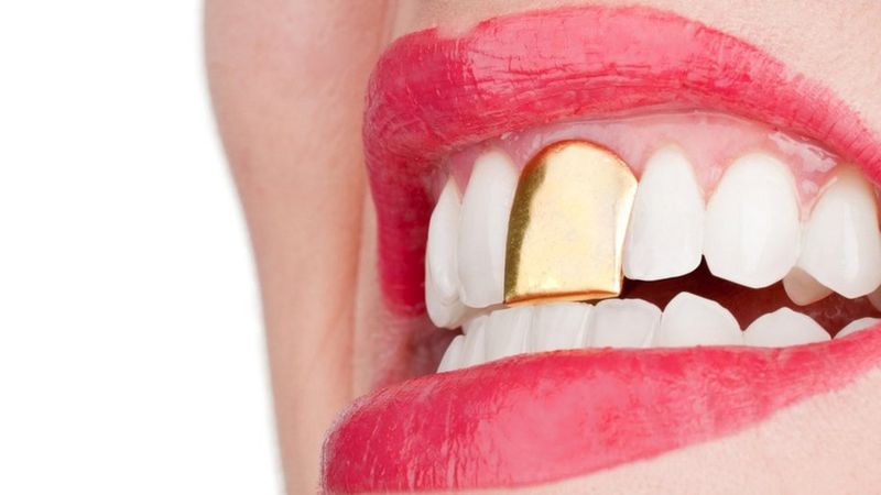 موارد استفاده از روکش دندان طلا | بهترین ایمپلنت اصفهان | دکتر ندا مکانیک