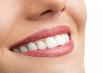 نکات مراقبتی از دندان روکش شده | بهترین دندانپزشک زیبایی اصفهان | دکتر ندا مکانیک