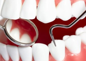 بهترین ایمپلنت اصفهان | بهترین دندانپزشک زیبایی اصفهان | کاربردهای لمینیت سرامیکی دندان | بهترین ایمپلنت اصفهان | دکتر ندا مکانیک