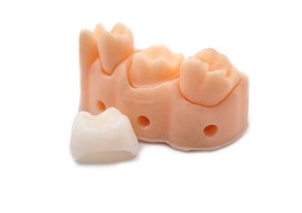 بهترین ایمپلنت اصفهان | بهترین دندانپزشک زیبایی اصفهان | دلایل احساس بزرگی روکش دندان | بهترین ایمپلنت اصفهان | دکتر ندا مکانیک