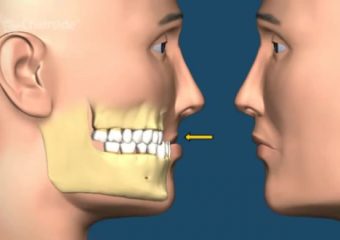 بهترین ایمپلنت اصفهان | بهترین دندانپزشک زیبایی اصفهان | علل اصلی کوچک بودن فک پایین | بهترین ایمپلنت اصفهان | دکتر ندا مکانیک