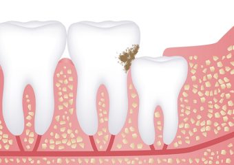 علل ایجاد پوسیدگی در دندان عقل | بهترین ایمپلنت اصفهان | دکتر ندا مکانیک