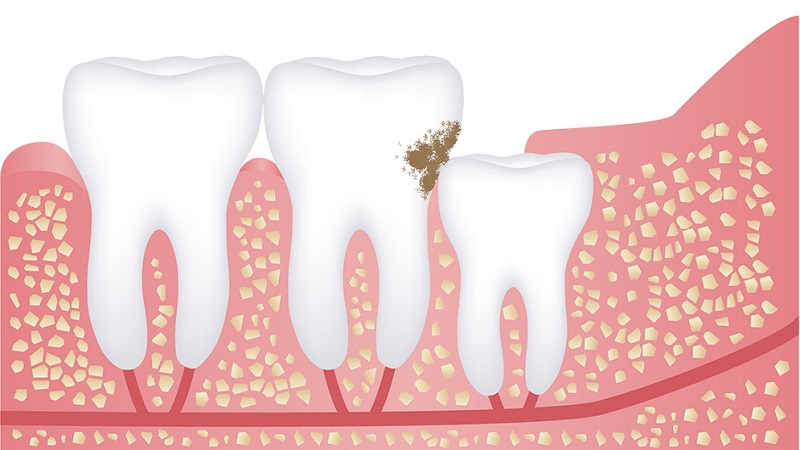علل ایجاد پوسیدگی در دندان عقل | بهترین ایمپلنت اصفهان | دکتر ندا مکانیک