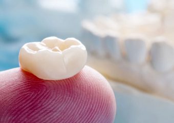 عوارض احتمالی داشتن تاج دندان | بهترین دندانپزشک زیبایی اصفهان | دکتر ندا مکانیک