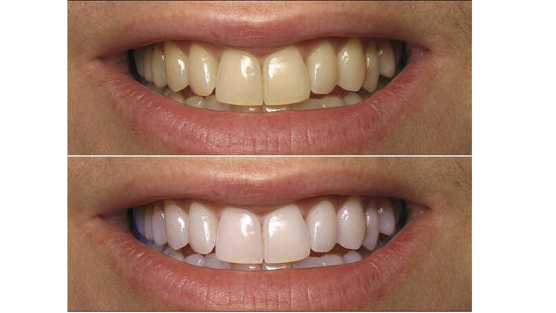 پیشگیری از تغییر رنگ لبه لمینت سرامیکی دندان | بهترین دندانپزشک زیبایی اصفهان | دکتر ندا مکانیک