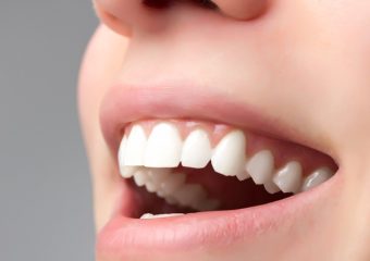 بهترین ایمپلنت اصفهان | بهترین دندانپزشک زیبایی اصفهان | آشنایی با روکش دندان متصل به هم | بهترین دندانپزشک کودکان اصفهان | دکتر ندا مکانیک