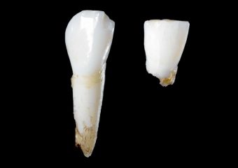 بهترین ایمپلنت اصفهان | بهترین دندانپزشک زیبایی اصفهان | تشخیص و درمان ریشه جامانده دندان | بهترین دندانپزشک کودکان اصفهان | دکتر ندا مکانیک