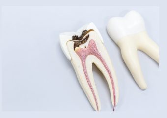 بهترین ایمپلنت اصفهان | بهترین دندانپزشک زیبایی اصفهان | خطرات توجه نکردن به‌ سلامت ریشه دندان | بهترین دندانپزشک اصفهان | دکتر ندا مکانیک