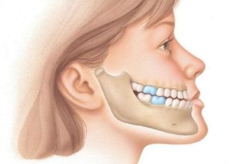 بهترین ایمپلنت اصفهان | درمان جلو بودن دندان و فک پایین | بهترین دندانپزشک زیبایی اصفهان | دکتر ندا مکانیک
