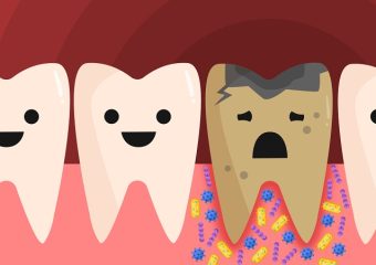 راه های پیشگیری و درمان پوسیدگی دندان عقل | بهترین ایمپلنت اصفهان | دکتر ندا مکانیک