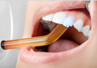 بهترین ایمپلنت اصفهان | نکاتی پیرامون پر کردن دندان جلو | بهترین دندانپزشک زیبایی اصفهان | دکتر ندا مکانیک