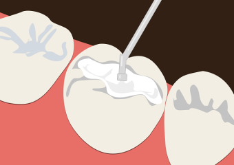 پیشگیری از علل ریختن دیواره دندان پر شده | بهترین دندانپزشک زیبایی اصفهان | دکتر ندا مکانیک