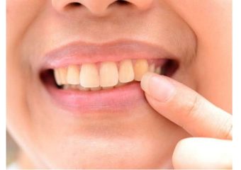 بهترین ایمپلنت اصفهان | بهترین دندانپزشک زیبایی اصفهان | پیشگیری و درمان لکه زرد روی دندان | بهترین دندانپزشک کودکان اصفهان | دکتر ندا مکانیک