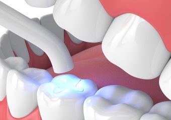 بهترین ایمپلنت اصفهان | بهترین دندانپزشک زیبایی اصفهان | کاربردهای کامپوزیت ips دندان | بهترین دندانپزشک اصفهان | دکتر ندا مکانیک