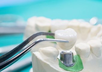 انواع روکش برای ایمپلنت دندان | بهترین ایمپلنت اصفهان | دکتر ندا مکانیک