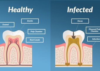 اهمیت کشیدن ریشه دندان عفونی | بهترین ایمپلنت اصفهان | دکتر ندا مکانیک