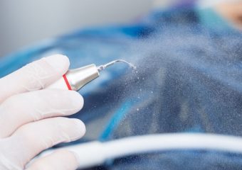 جرم گیری دندان با فشار آب | بهترین ایمپلنت اصفهان | دکتر ندا مکانیک